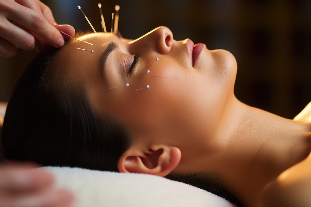 Woman in an acupuncture therapy on head